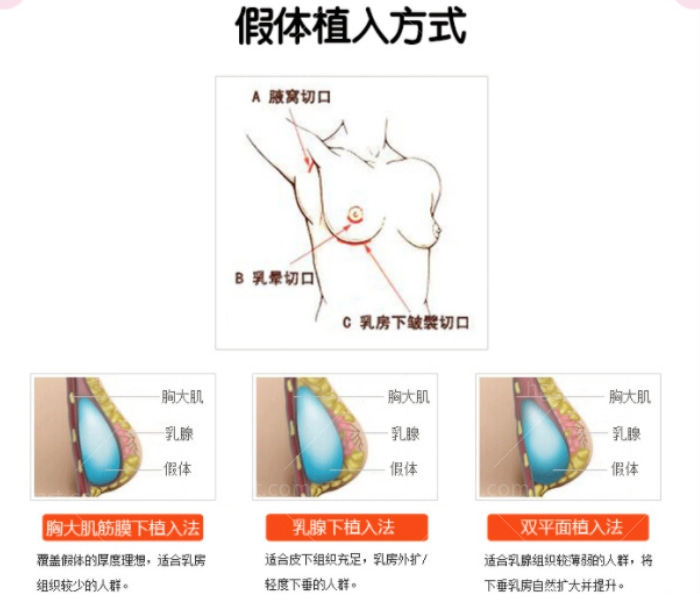 西安隆胸哪里好？西美整形外科全新的内窥镜隆胸技术了解下！