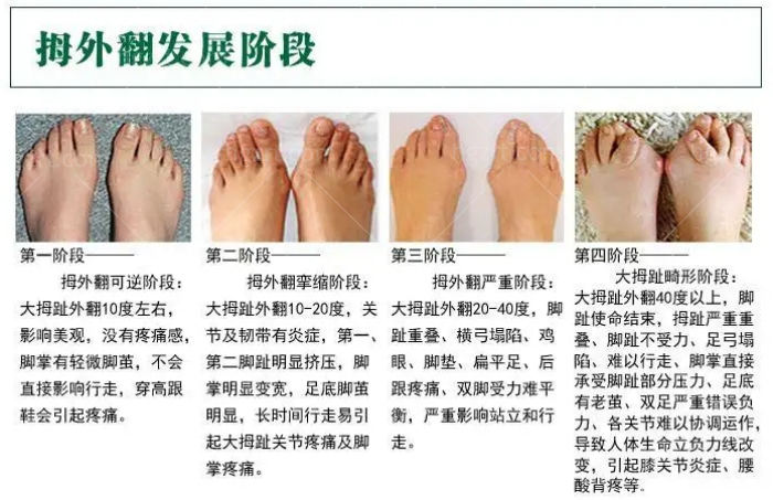 北京大脚骨整形推荐邱立东医生!技术这么好的大脚骨矫正术医生YYDS!