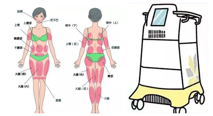 重庆去做酷塑冷冻溶脂哪家医院正规靠谱 冷冻溶脂做一次多少钱