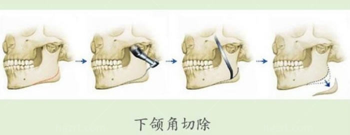 广州沈绍勇做磨骨怎么样