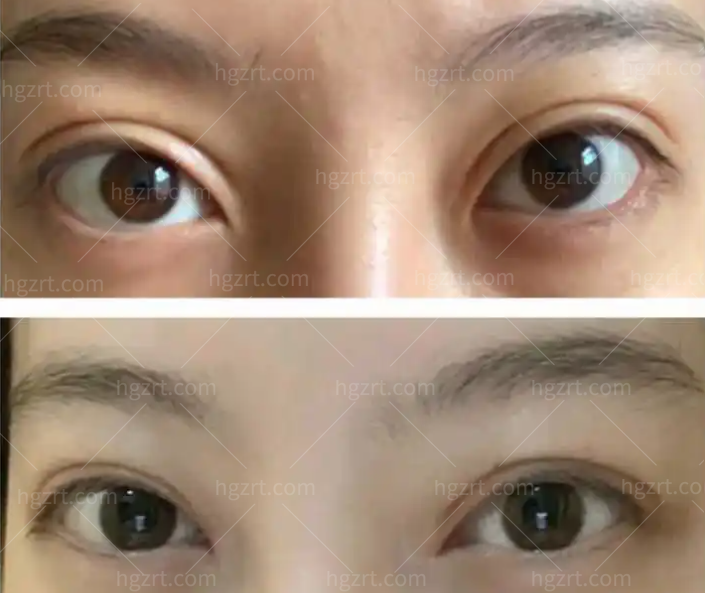 我不允许你不知道！2022年更新上海双眼皮修复厉害的医生和上海双眼皮修复医生推荐