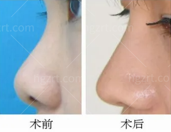 一整个爱住了！杨季涛鼻子的体验图片，你猜杨季涛做鼻子好吗？