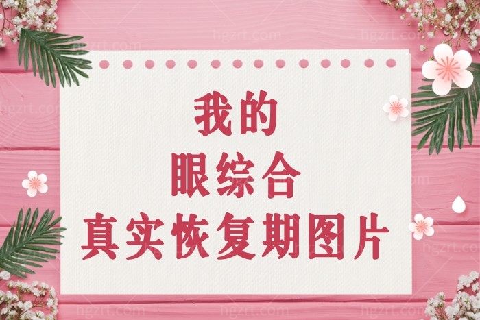 OMG！要看我的眼综合真实恢复期图片？还是来听听我的双眼皮经历分享吧