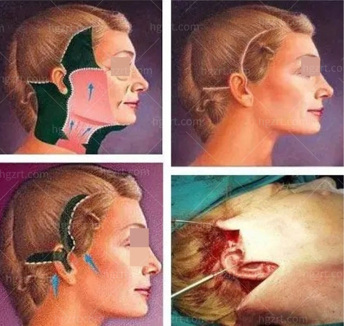 昆明小拉皮手术谁做得好