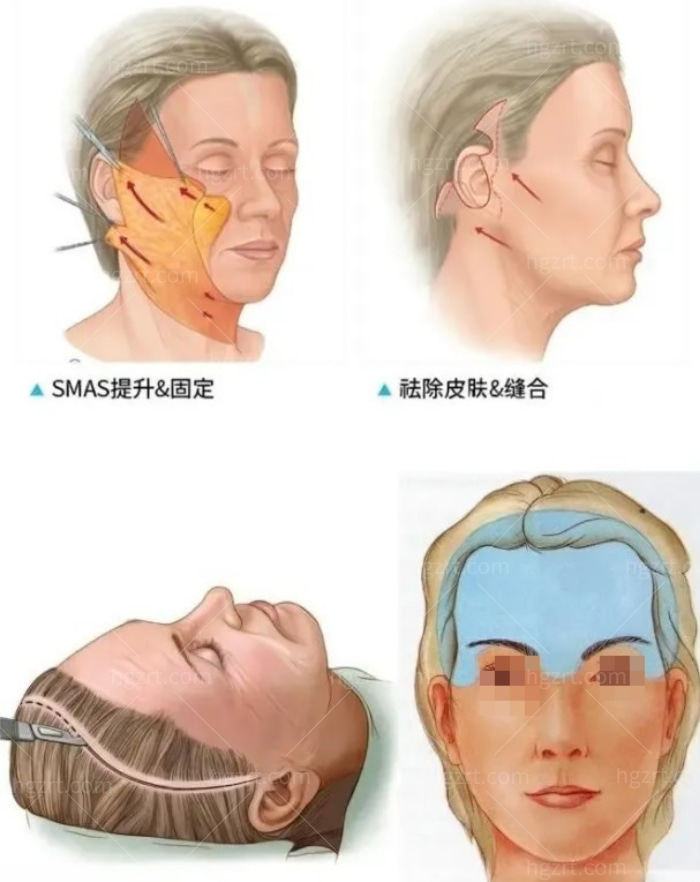 昆明小拉皮手术谁做得好