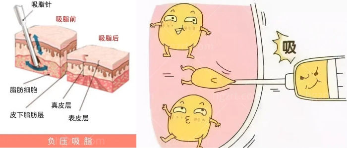 吸脂手术原理