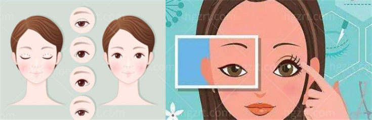 王贵雄双眼皮手术口碑怎么样