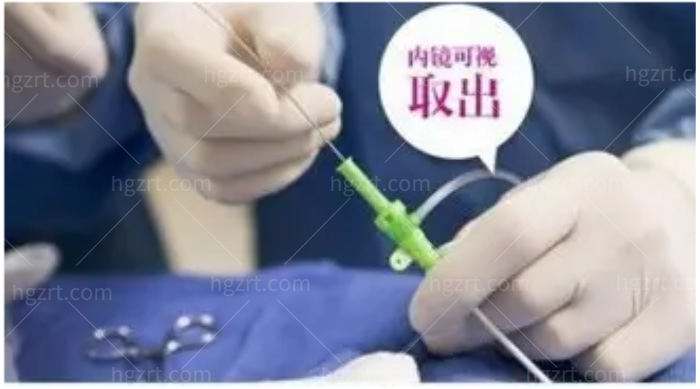 内窥镜可视清奥