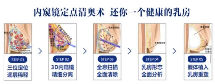 内窥镜定点清奥术