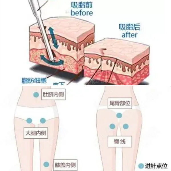 昆明吸脂比较好的医院.jpg