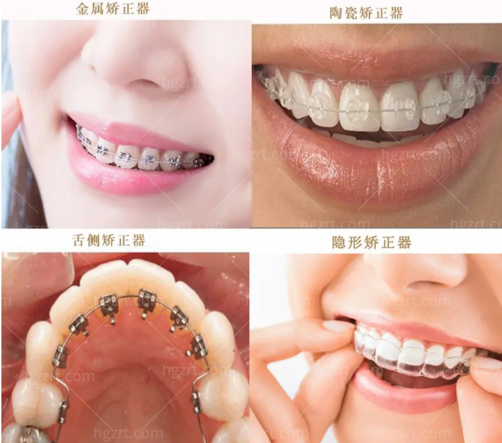 恩施凯恩口腔医院暑期牙齿矫正活动开启啦，不到5000就可以做金属自锁矫正