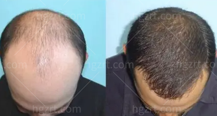 衡阳雅美父亲节放大招了！拯救脱发免费植发，挖到宝了！