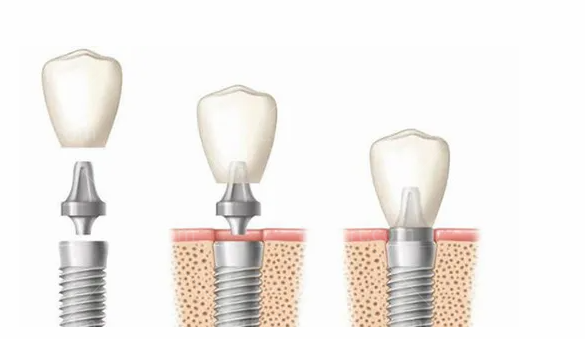 海曙口腔医院3500就可以种植牙，解决缺牙问题，不在望而却步，来看看**种植牙是不是可以报销