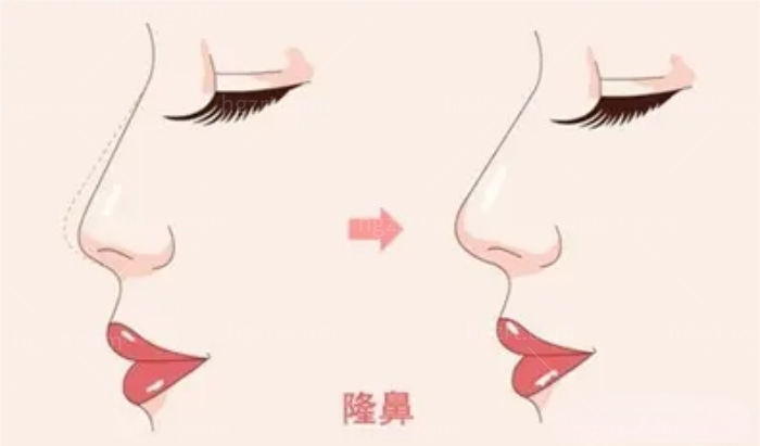 隆鼻示图