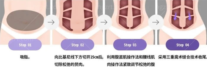 广州腹壁整形术好的医院