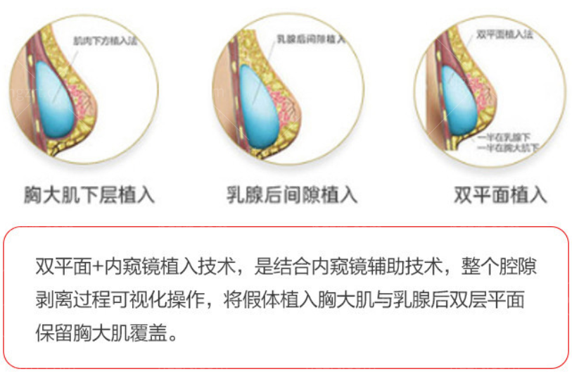 三种常见隆胸技术