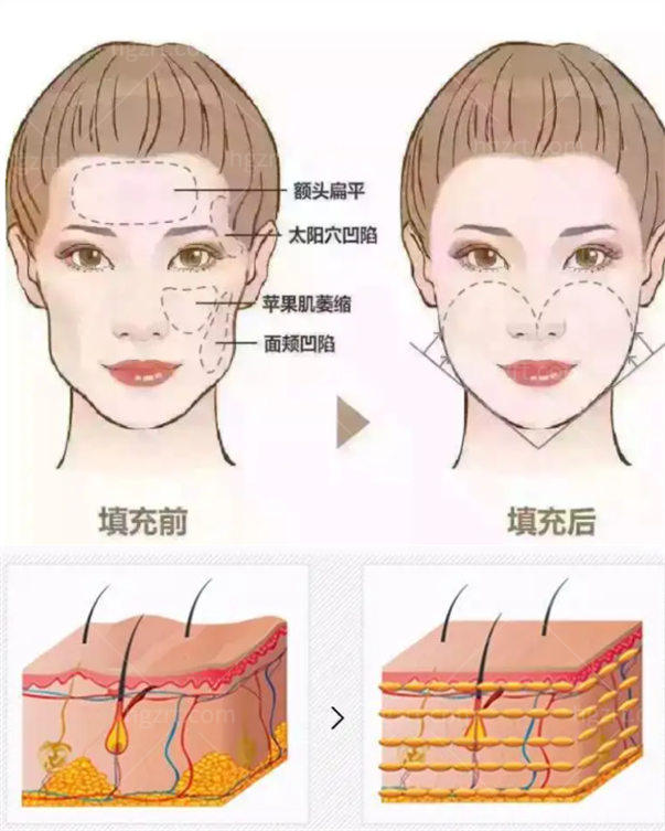 全脸脂肪填充可以做到自然感吗 教你如何填充不踩雷