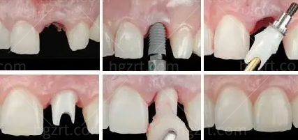 谁还没拥有北京万柳优合口腔的种植牙简直爱上！