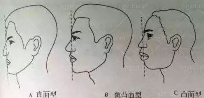 做凸嘴手术多少钱