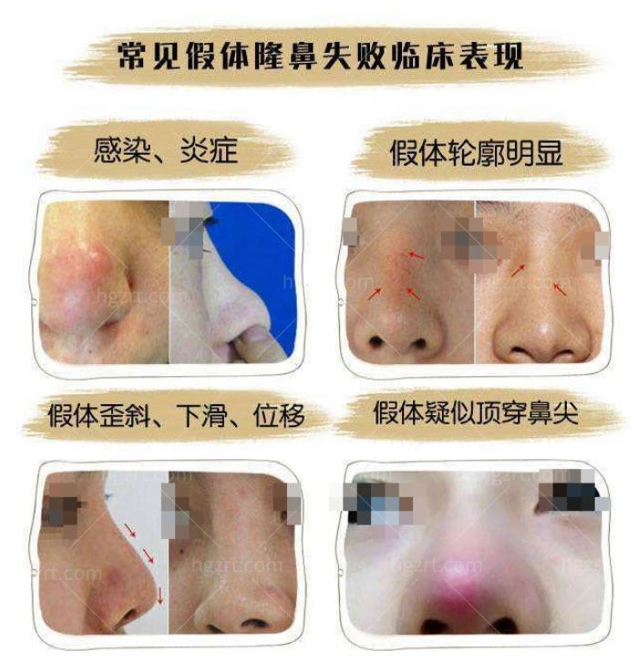 成都哪家医院做鼻子口碑好