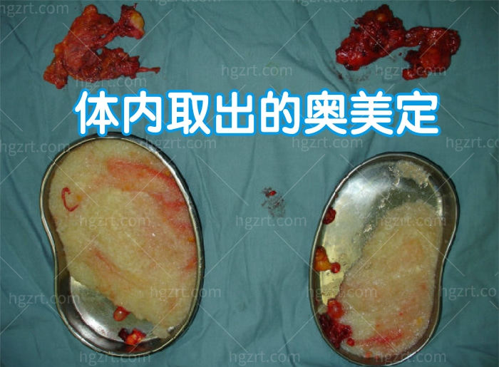 奥美定取出异物图片示例