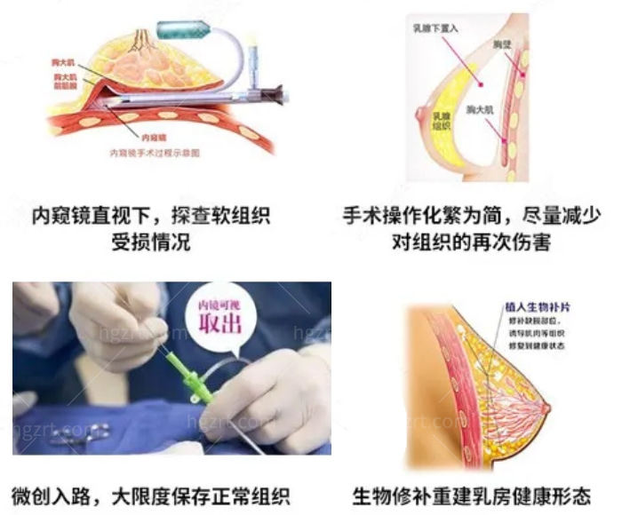 胸部奥美定取出手术