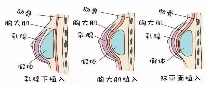 泰国隆胸有没国内那么痛