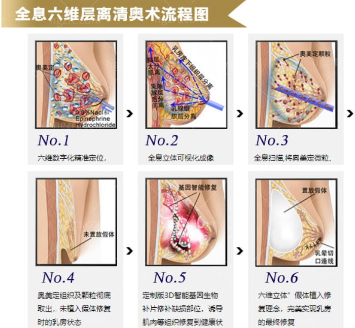 广州荔医的全息六维层离清奥术