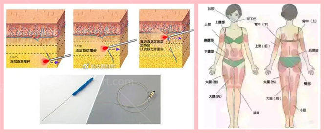 局部胖<span style=