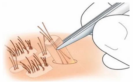 北京丽格医疗美容医院植发2000毛囊单位包干！