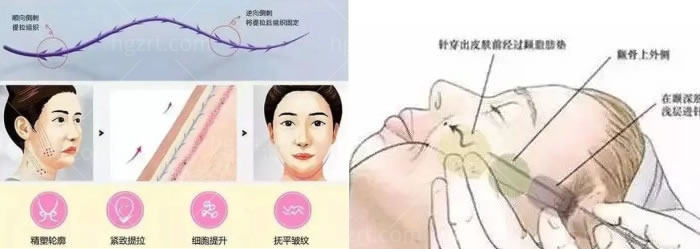 重庆华美和军美哪家做埋线好