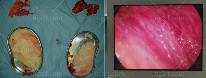 重庆奥美定取出好医院