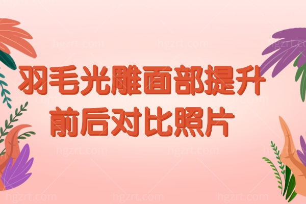 羽毛光雕面部提升.jpg