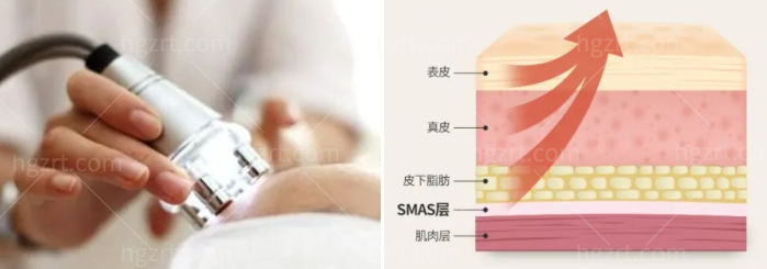羽毛光雕面部提升.jpg