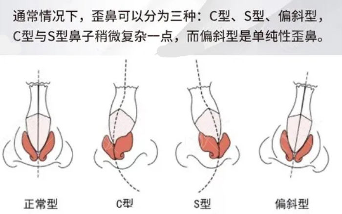 歪鼻修复