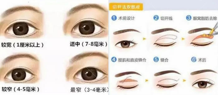 郑州孟明星医生修复大小眼的例子和双眼皮修复价格