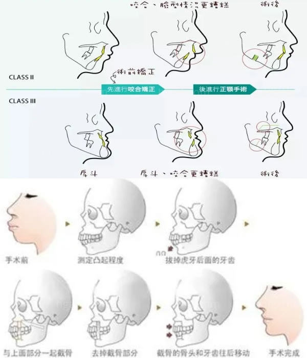 广州正颌手术.jpg