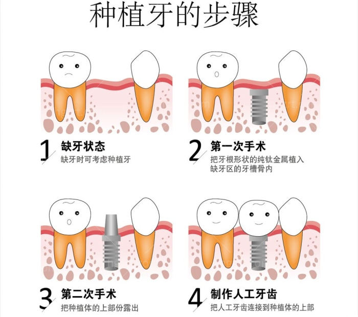 种植牙步骤流程图