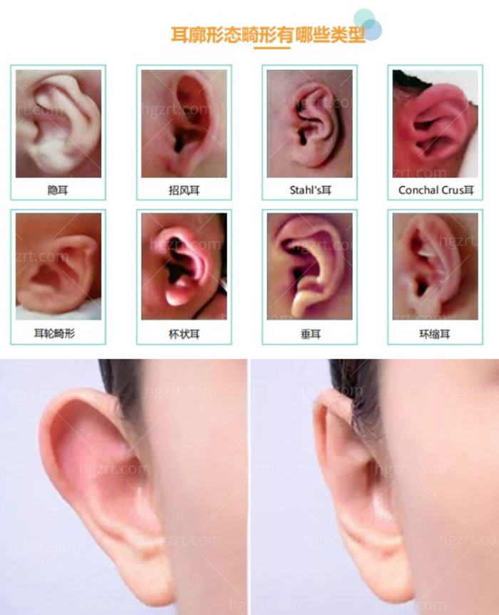 耳畸形图