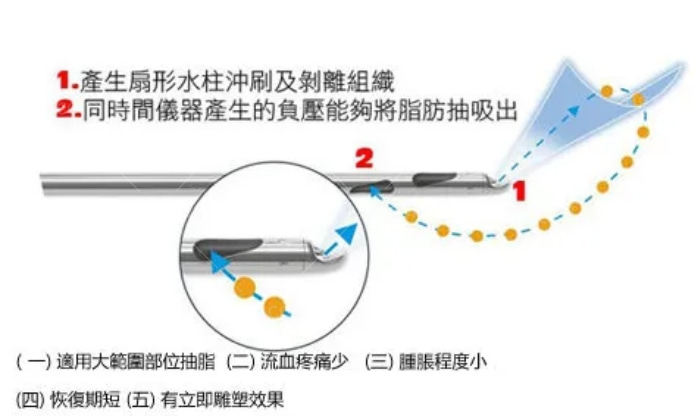 土麦森吸脂和水动力吸脂.jpg