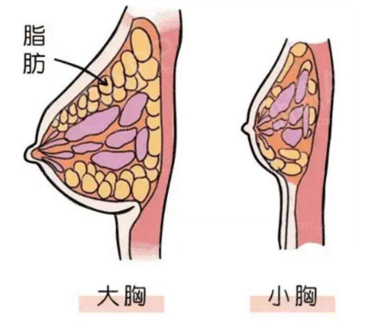 雕刻脂肪是什么