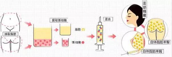 雕刻脂肪是什么