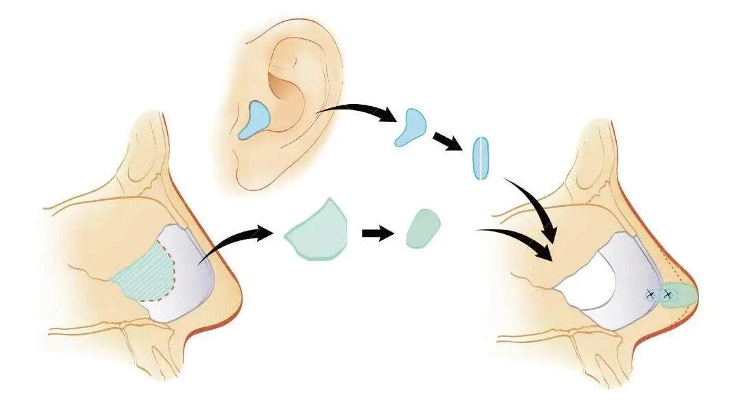 自体软骨鼻部整形