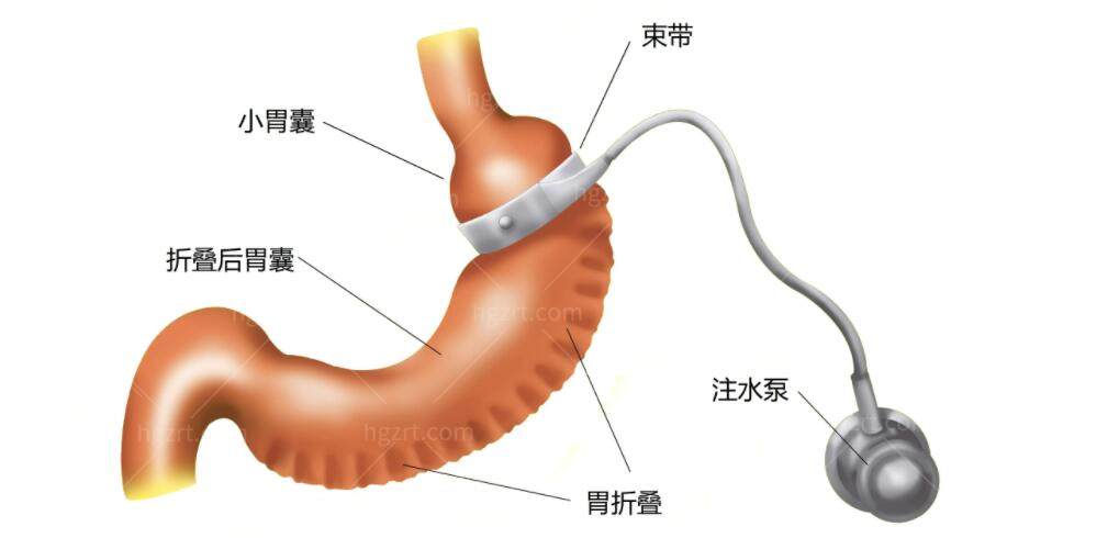 体型矫正