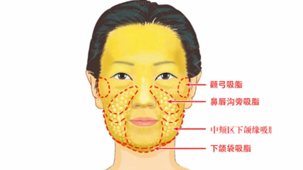 立體整形微調,韓國tzone立體整形聽說過嗎?