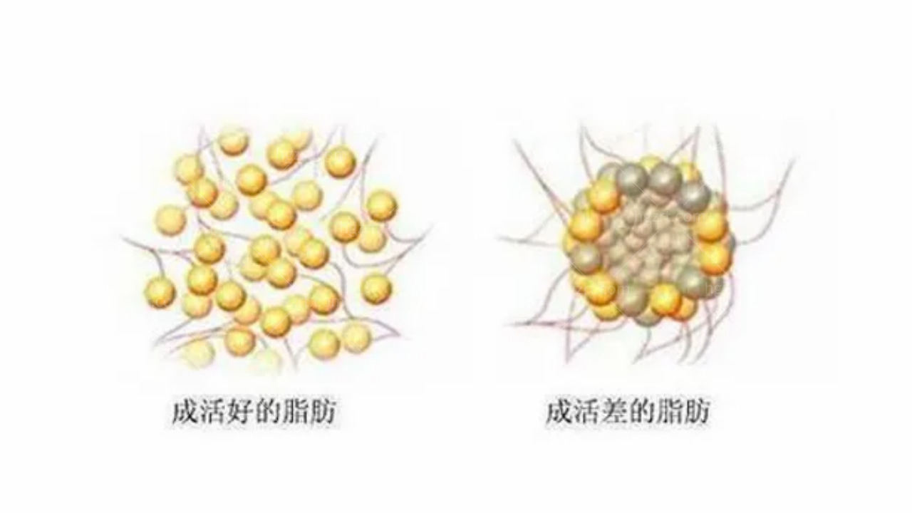 自体脂肪移植部位不同存活率也有差异吗？求解！