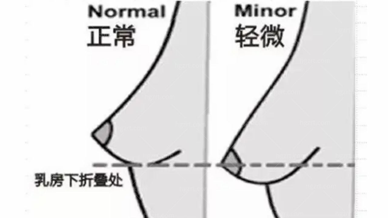 胸下垂还能矫正回来吗？来看乳房过大如何缩小？