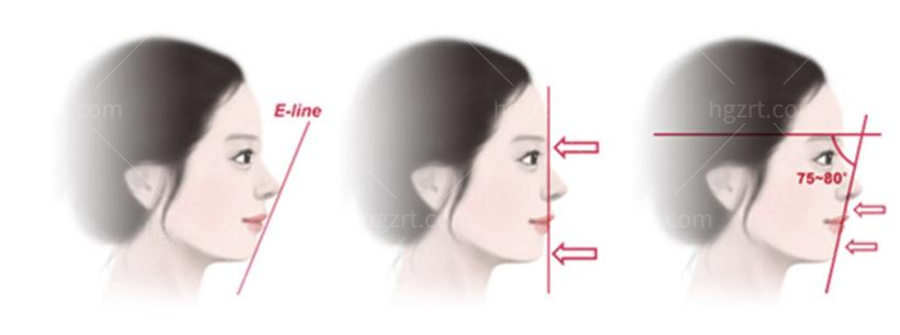 突嘴手术与双颚手术有什么差别呢 ?让你一键消除突嘴困扰