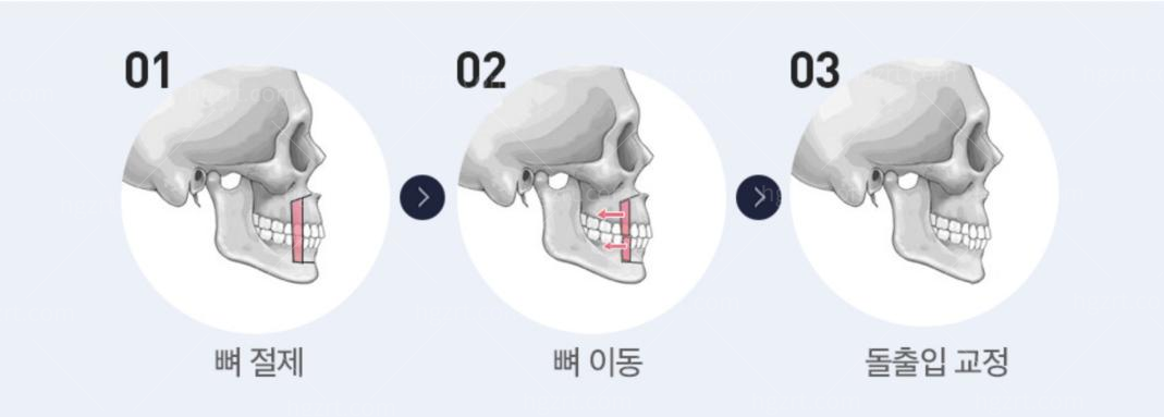 突嘴手术与双颚手术有什么差别呢 ?让你一键消除突嘴困扰