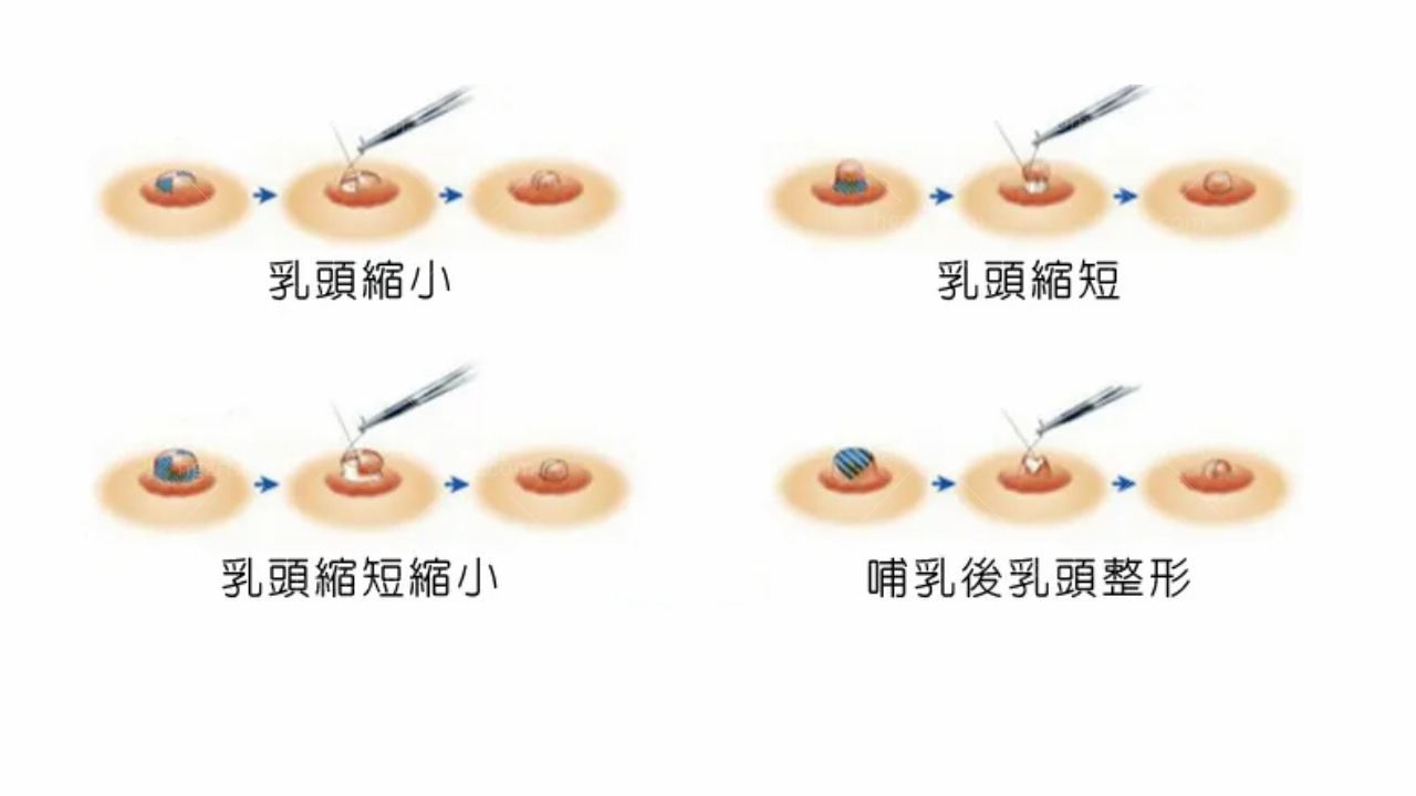 内陷乳头矫正和3D乳头缩小术之间的区别是什么？